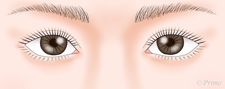 下眼瞼拡大術（たれ目形成）イラスト